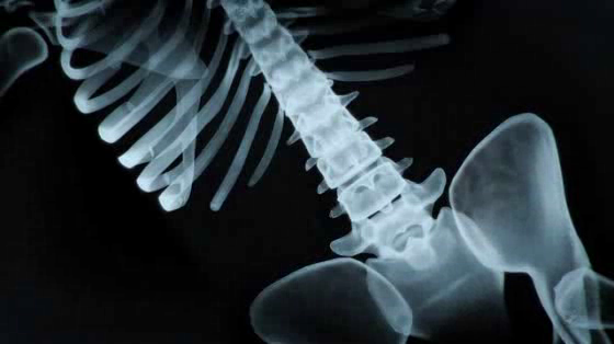Road Safety - Speed: Speeding shatters lives - spine
