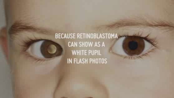Childhood Eye Cancer Trust: Detect Eye Cancer