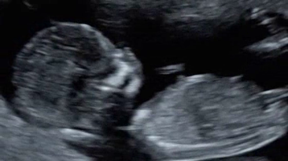 ITV: Conversations - Ultrasound